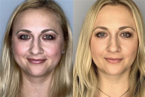 buccal fat removal 10 years later|10 Years Later Lasting Effects of Buccal Fat Removal